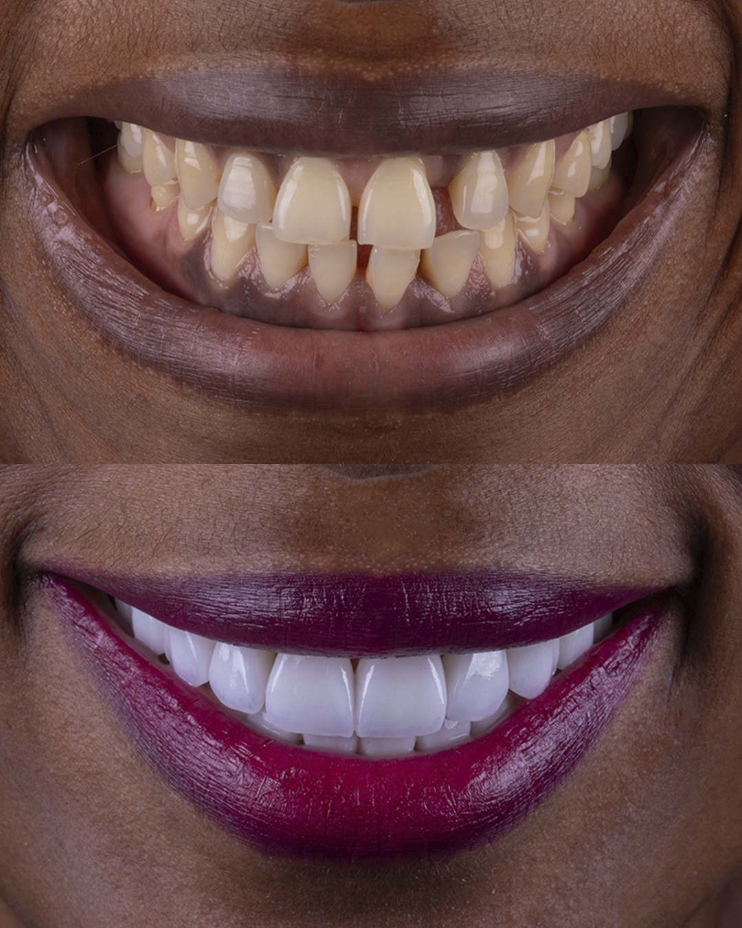 ANTES / DEPOIS