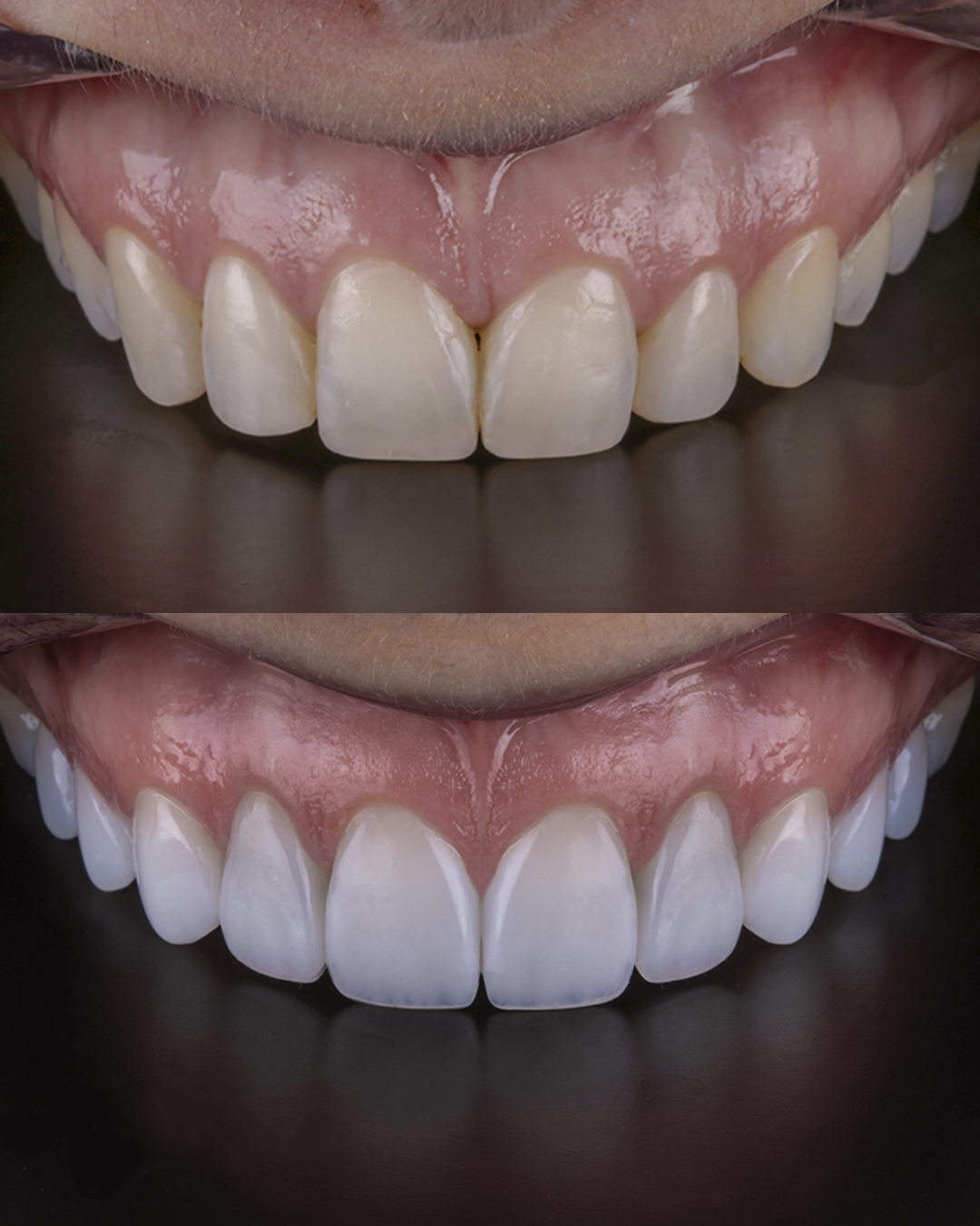 ANTES / DEPOIS